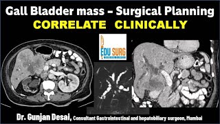 Gall Bladder cancer Surgical planning on CT scan Triphasic CT liver protocol  Correlate clinically [upl. by Ariane]