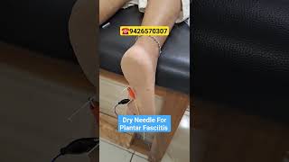 Dry Needle For Plantar FasciitisPlantar Fasciitis PainFoot PainDry Needle Foot PainDrAnup [upl. by Patrick]