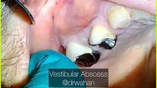 Vestibular Abscess Incision and Drainage Step byStep with tooth extraction drwahan [upl. by Nirihs968]