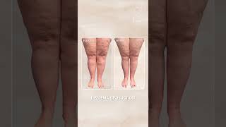 Lipedema Liposuction Before amp After Results  Salameh Plastic Surgery [upl. by Trilbee]