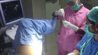 Endometritic Cyst  Chocolate cyst  Ovarian Cyst Removal  ARC Fertility Centre India [upl. by Esli]