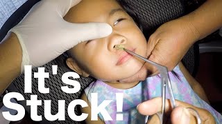 Something STUCK in Girls Nose for Months Removed What is It [upl. by Robby169]