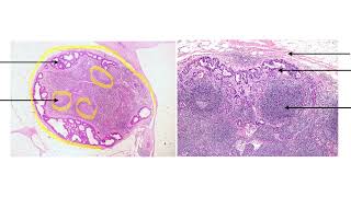 ADENOCARCINOMA METASTASIS TO LYMPH NODE [upl. by Ayimat]