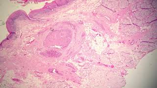 Well Differentiated Squamous Cell Carcinoma Verrucous Type [upl. by Nnyliram121]