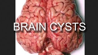 Brain Cyst Removal Arachnoid Cyst Everything You Need to Know [upl. by Nirtiac]