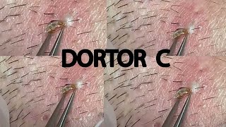 REMOVING INFECTED INGROWN HAIR 12 [upl. by Clarabelle210]