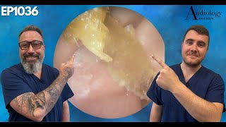 Tremors Make This Ear Wax Removal Extra Challenging  EP1036 [upl. by Aeriela]