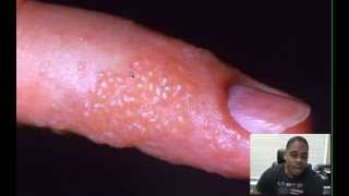 Will Herpes Cause An Outbreaks On Finger The Underground Cure [upl. by Berthe]