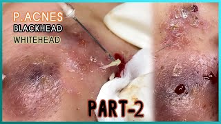 Big Cystic Acne Blackheads Extraction Blackheads amp Milia Whiteheads Removal Pimple Popping [upl. by Hseyaj434]