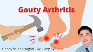 Gouty Arthritis  Dr Gary Sy [upl. by Acinok385]