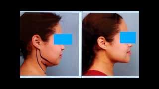 Sculpt the Chin amp Neck With Liposuction  Dr Sterry Explains [upl. by Abigail315]