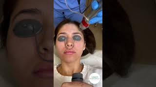 Erbium Laser easy and fast treatment [upl. by Eniamart]