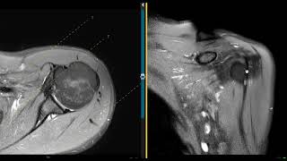 Shoulder pain in 26 year old No trauma [upl. by Dunson]