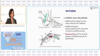 Le Rhumatisme Psoriasique  une prise en charge en pleine mutation [upl. by Warchaw857]