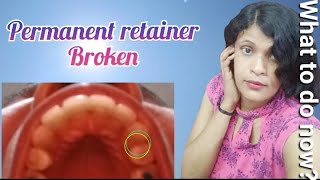 Retainer Broke  Metal retainer broke  Permanent retainer happysstyle priyankaartiyadav6298 [upl. by Kristen]