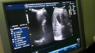 Chronic cystitis Ultrasound [upl. by Emmerich]