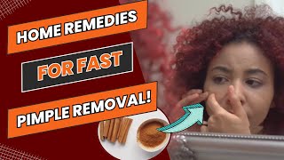 How to Get Rid of Pimples Overnight  Pimples Se Chutkara Kaise Paye pimpleremoval [upl. by Alyag]