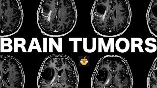 Brain Tumors [upl. by Llehsor]