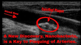 Science Behind Nanobacteria and Calcification of Arteries [upl. by Kip732]