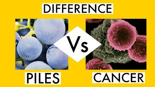 PILES BAVASIR Vs ANAL CANCER  DIFFERENCE  Symptoms बवासीर है या कैंसर [upl. by Arabelle]