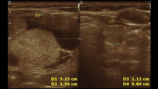 Hyperplastic adenomatous nodule  Complex nodule  Thyroid nodule [upl. by Asiela]