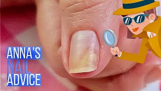 Nail Separation  Causes  Early Treatment of Onycholysis Annas Nail Advice [upl. by Isawk]