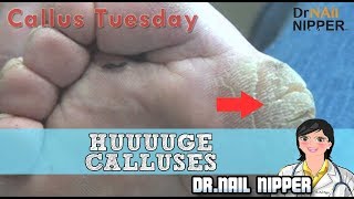 Absolute Monster Callus HUUUUGE Foot Calluses 26  Callus Tuesday Huge Callus [upl. by Epps]