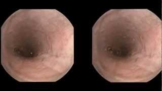 Esophageal varices detected by capsule endoscopy [upl. by Treulich609]