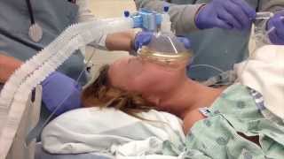 Rapid Sequence Induction with Cricoid Pressure and without Ventilation [upl. by Feirahs935]