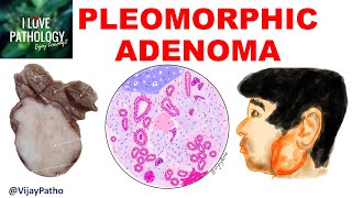 PLEOMORPHIC ADENOMA Etiopathogenesis Clinical features Gross and Microscopic features [upl. by Yerbua]