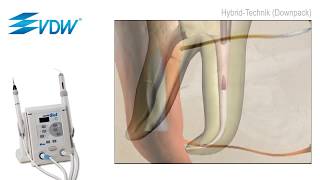 VDW Dental · How To VDW BeeFill 2in1  Obturationstechniken [upl. by Ahsinyt]