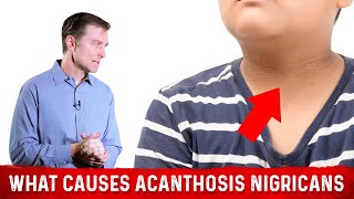 What Causes Acanthosis Nigricans Darkened Skin Folds – Dr Berg [upl. by Haidej]