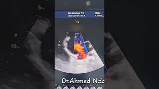 Large ASD Secundum Dilated Rt side😱😲 echocardiogram echocardiography heart cardiology asd [upl. by Ainattirb]