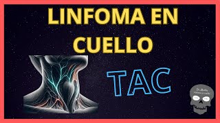 LINFOMA en el CUELLO👉Hallazgos en TOMOGRAFÍA [upl. by Nueoras229]