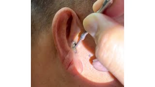 Removing Grandpas 70 Year Old Hard Earwax [upl. by Marijn147]