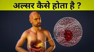 पेट में अल्सर कैसे होता हैं   cause of stomach ulcer [upl. by Terina351]