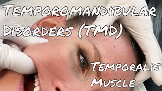 TMJ Pain  Temporalis Release  Motion Specific Release [upl. by Edras]