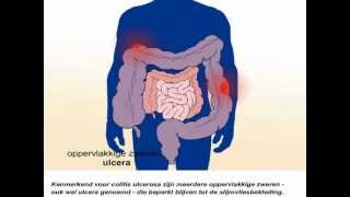 Colitis ulcerosa  Wat zijn de symptomen en behandeling van colitis ulcerosa [upl. by Hanah]