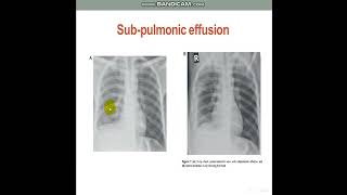 PleuralEffusionDiagnosticApproach [upl. by Ruy42]