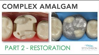 Complex Amalgam Restoration  Part 2 [upl. by Leumas]