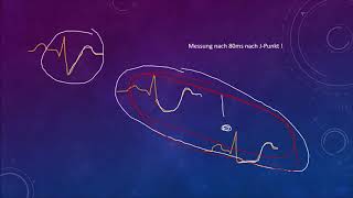 EKG Crashkurs Teil 4 STHebung STSenkung Hypertrophie [upl. by Rolyks]