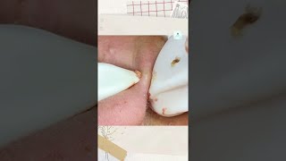 Big Cystic Acne Blackheads Extraction Blackheads amp Milia Whiteheads Removal Pimple Popping shorts [upl. by Sapers383]