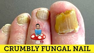 CUTTING OF SUPER CRUMBLY FUNGAL NAIL  TWO NAILS IN ONE [upl. by Loella177]