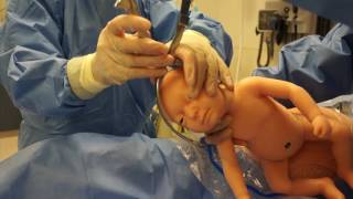 ForcepsAssisted Cesarean [upl. by Stimson]