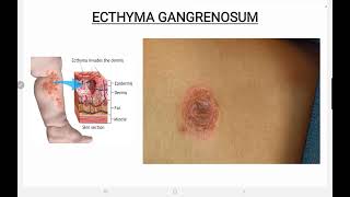 Ecthyma Gangrenosum [upl. by Searle157]