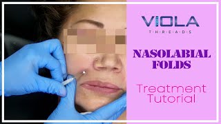 Viola Threads Nasolabial Folds Treatment Tutorial featuring Mesh Threads [upl. by Imehon387]