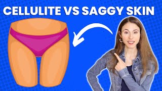 CELLULITE VS SAGGY SKIN ON THIGHS 🤔 DERMATOLOGIST DrDrayzday [upl. by Crandale]