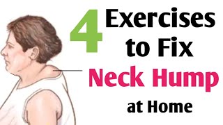 Neck Hump exercises at home  Buffalo Hump  Dowagers Hump  Hindi [upl. by Hars]