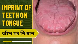 Imprint of teeth on Tongue  scalloped Tongue  जीभ पर दात के निशान  stress  vitamin  smoking [upl. by Tadeas]