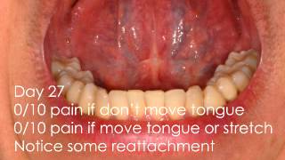 Laser Tongue Tie Revision Healing and Care Instructions [upl. by Blayne]